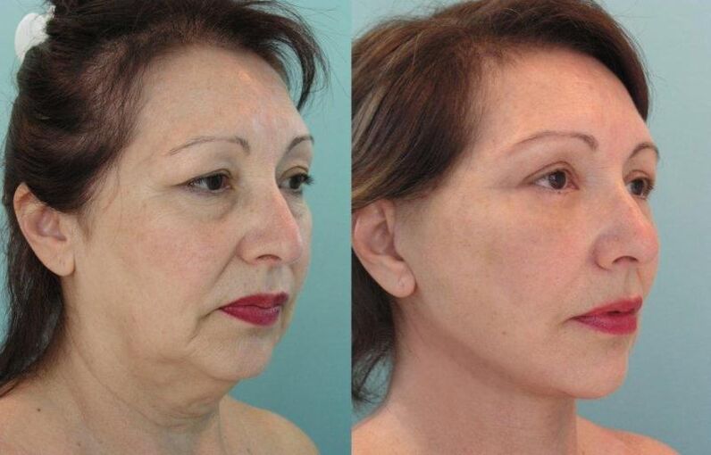 El resultado del rejuvenecimiento de la piel del rostro se tensa con hilos. 