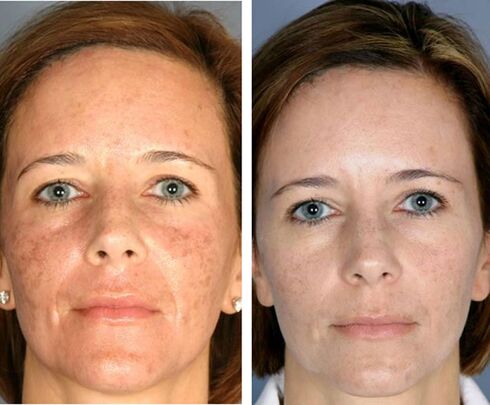 Antes y después de la termólisis facial fraccionada