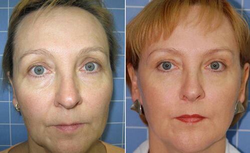 Antes y después del rejuvenecimiento facial con láser fraccionado