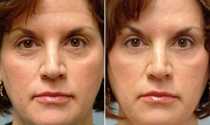 rostro antes y después de la refractura con láser